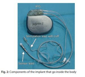 How To Run Hypoglossal Nerve Stimulation For Obstructive Sleep Disorder ...