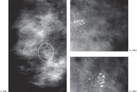 Multiple Clusters of Crushed Stone-like Calcifications on the Mammogram Produced by Malignant ...