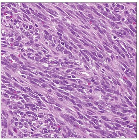 Synovial Sarcoma | Basicmedical Key