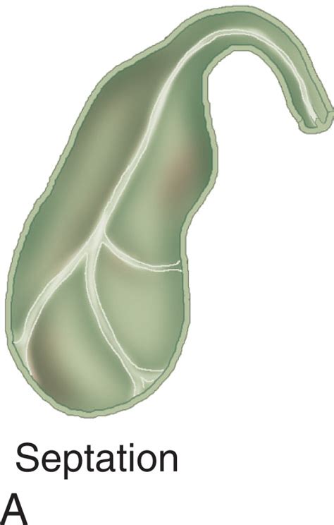 The Gallbladder and the Biliary System - Clinical Tree