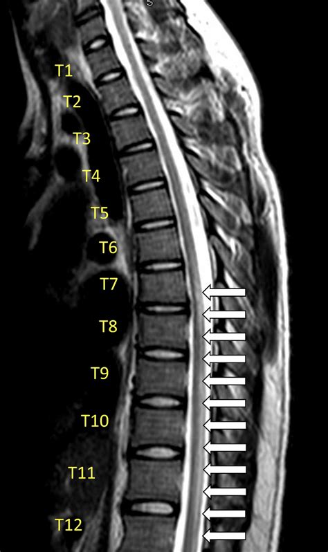 Acute Transverse Myelitis MRI - REBEL EM - Emergency Medicine Blog