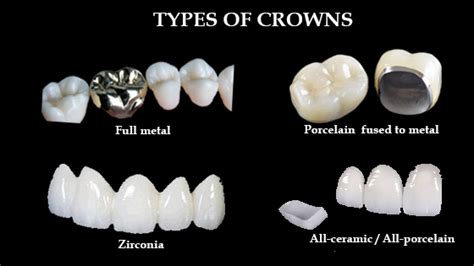 What Material Is A Dental Crown Made Up From? ~ Dr. Bharat Katarmal ...