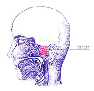 Nasopharyngeal Cancer