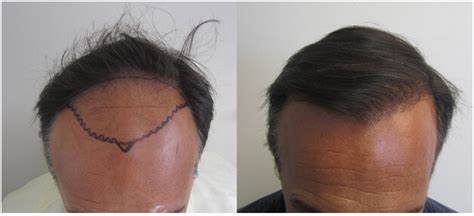 fue hair transplant cost california - Biggish Blogging Photo Galleries