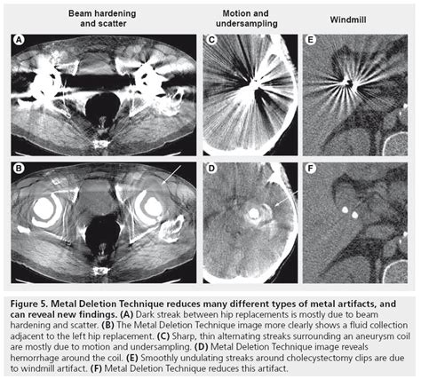 CT artifacts: causes and reduction techniques