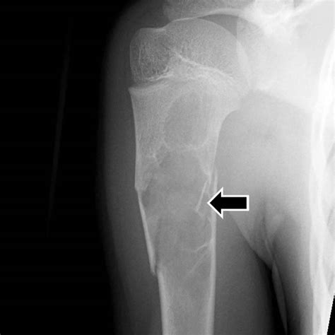 Bone cyst causes, symptoms, diagnosis, treatment & prognosis