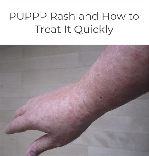 Twiniversity - Ugh. PUPPP rash is awful. ☹️...