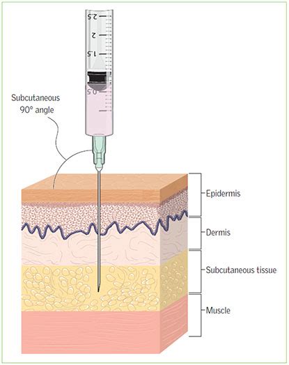 Heparin Subcutaneous Injection Sites