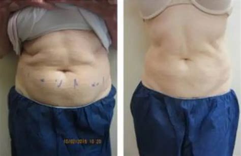 CoolSculpting Stomach Costs: Everything You Need To Know