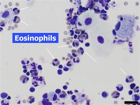 000 Acute Eosinophilic Pneumonia (AEP) | Lungs