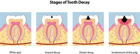 Stages Of Tooth Decay