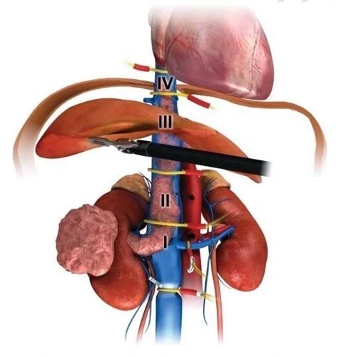 In a Study, Robotic Kidney Cancer Surgery Yielded Favorable Results ...