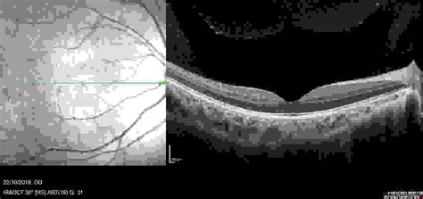 How To Fix A Wrinkled Retina at Richard Gaines blog