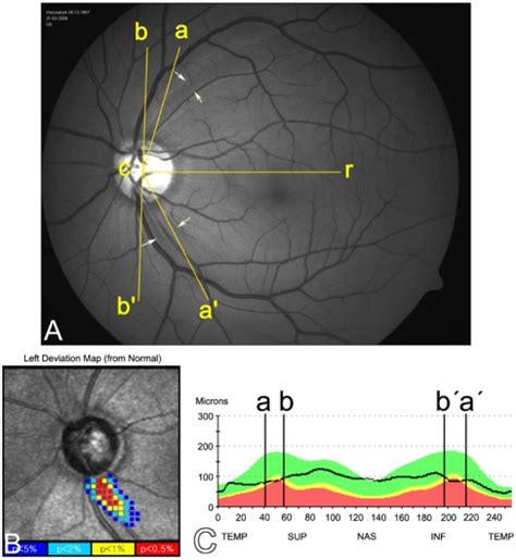 Topographic measurements of focal retinal nerve fiber layer (RNFL)... | Download Scientific Diagram