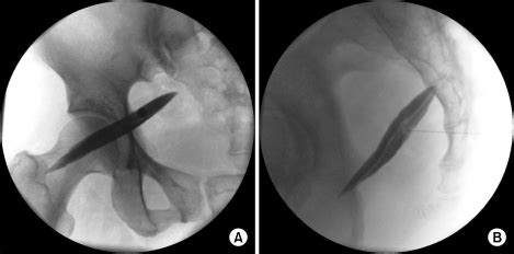 Piriformis injection under fluoroscope. (A) Anteroposte | Open-i