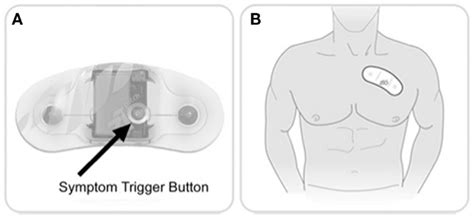 Ziopatch cardiac monitor. Zio Patch button and placement. (A) Patients ...