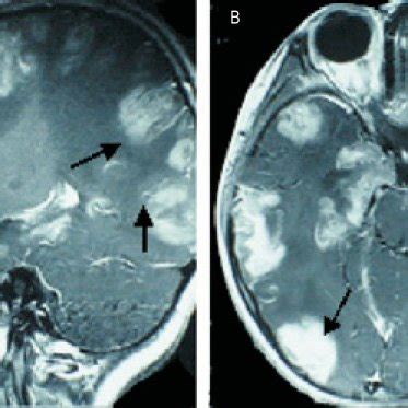 MRI scans of the brain with contrast-T1 sagittal (A) and axial (B ...