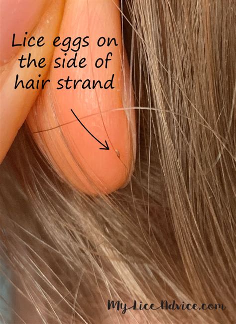 Pictures of What Lice Eggs (Nits) Look Like in Hair: 9 Tips to Spot Them