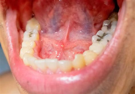 Sublingual Gland Stone Disease in Mouth Stock Image - Image of closeup, blood: 141352655