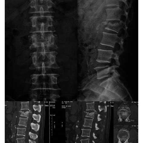 AP and lateral X-rays showing good coronal and sagittal alignments 12 ...