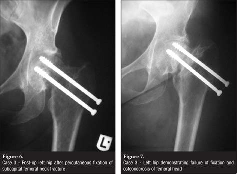 Subcapital Left Femoral Neck Fracture