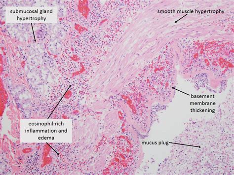 Asthma Histology