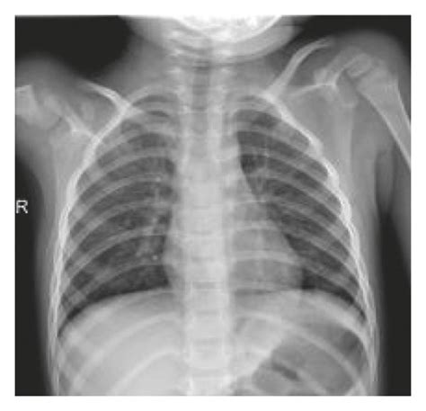 Chest X-ray images. (a) COVID-19, (b) COVID-19, (c) normal, (d) normal ...