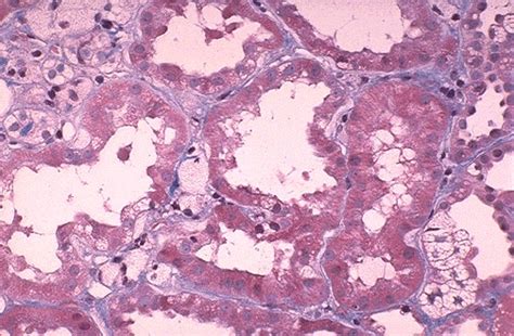 Pathology Outlines - Alport syndrome