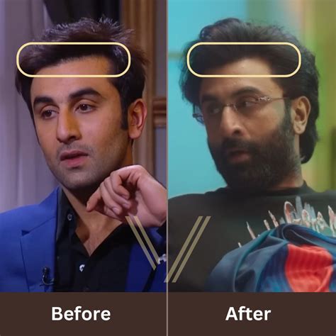 Ranbir Kapoor Hair Transplant: Before and After Result