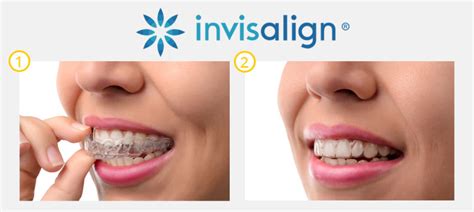 Invisalign Provider Bonita Springs - Clear Braces - SMILE Dental