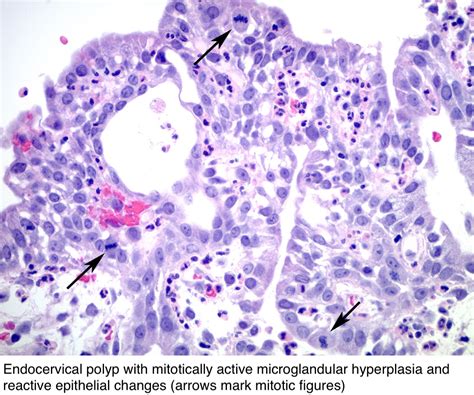 Pathology Outlines - Endocervical polyp