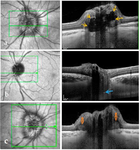 Figure 1 from OCT Based Interpretation of the Optic Nerve Head Anatomy ...