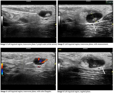 Case of the Month July 2021- Palpable inguinal lymph nodes – WFUMB