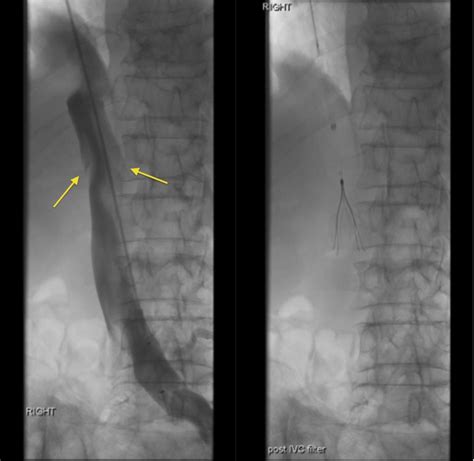 IVC filter insertion - Radiology at St. Vincent's University Hospital