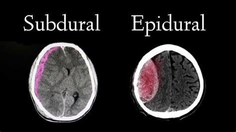 Subdural vs Epidural Hematoma: CT Findings, Location, Symptoms, and Pathophysiology — EZmed