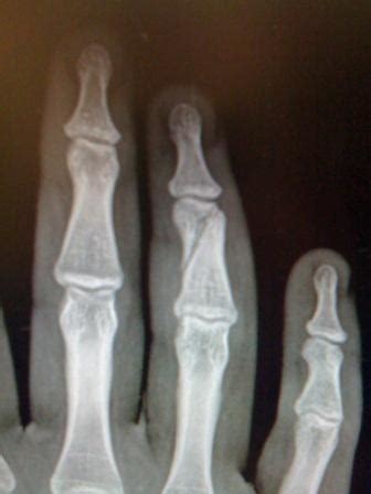 Middle phalangeal fracture - Melbourne Hand Surgery