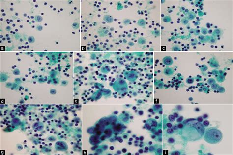 The panorama of different faces of mesothelial cells - CytoJournal