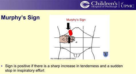 Positive Murphy Sign : Murphy S Sign Clinical Examination Of The ...