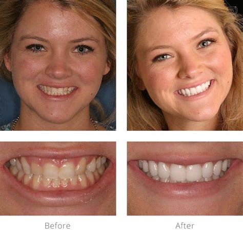 Lexington, KY Gum Lift Gummy Smile Correction - Arnold Dental