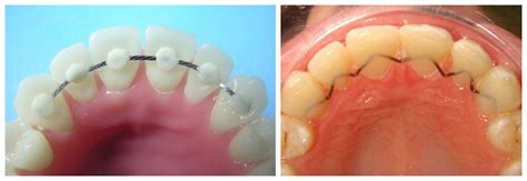 Magic of a Retainer: Before and After Photos to Prove It | New Health Advisor