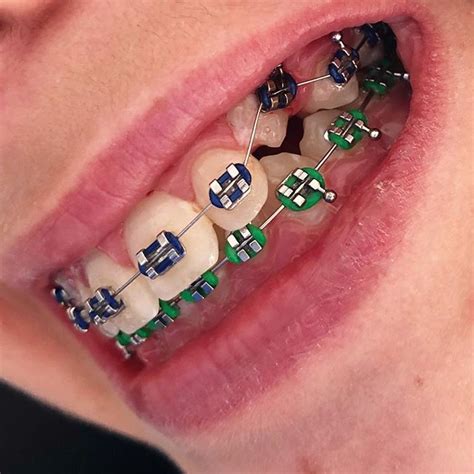 Braces Colors: Which One Is Best For You | Braces Explained