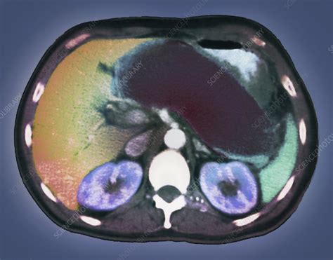 Pancreatitis, CT scan - Stock Image - C004/1403 - Science Photo Library