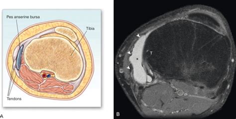 Pes Anserine Bursitis | Anesthesia Key