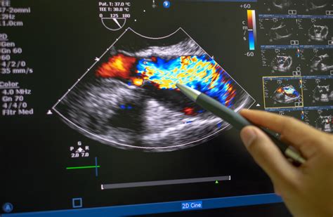 Echocardiography (ultrasound). - Parker University