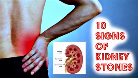 10 Signs of Kidney Stones - YouTube