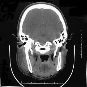 Fracture of the styloid process associated with the mandible fracture – ScienceOpen