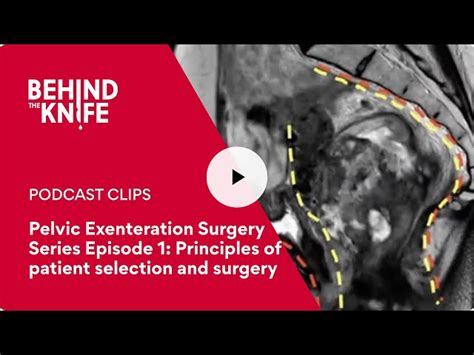 Pelvic Exenteration Surgery Series Episode 1: Principles of patient selection and surgery ...