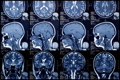 Single MRI scan promises to diagnose early- and late-stage Alzheimer’s