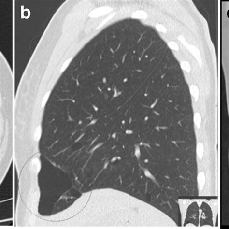 Diagnostic criteria for Birt-Hogg-Dubé syndrome | Download Scientific Diagram