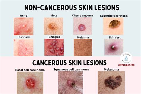 Skin Lesions: Types with Chart, Pictures, Causes, Treatment